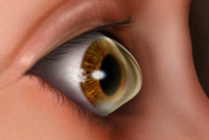 Осложнения и последствия после лазерной коррекции зрения