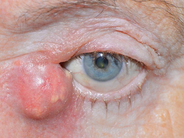 Дакриоцистит - воспаление слезного канала