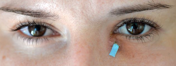 Воспаление слезного мешочка