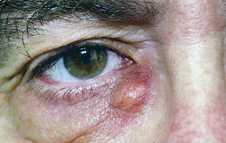 воспаление слезного мешка