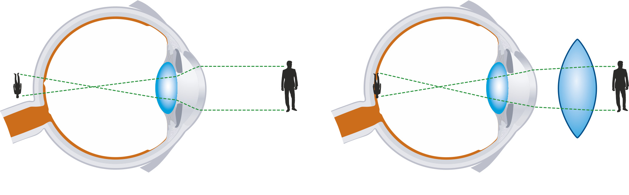 Дальнозоркость - это плюс или минус