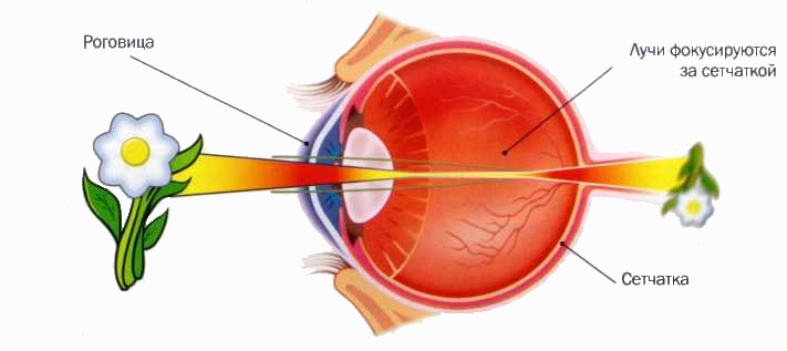 Что такое гиперметропия слабой степени (1 степень)