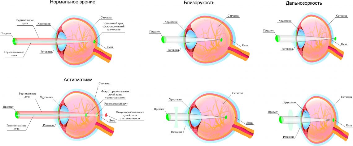 Нарушение рефракции глаза