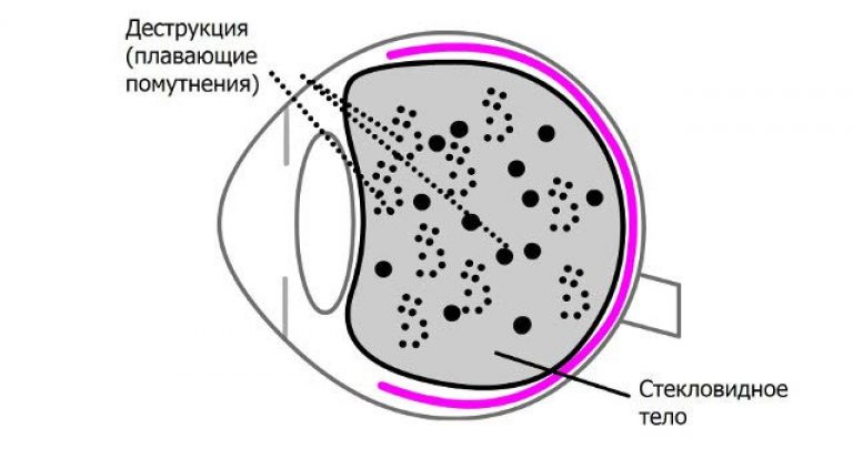 Плавающие помутнения в стекловидном теле