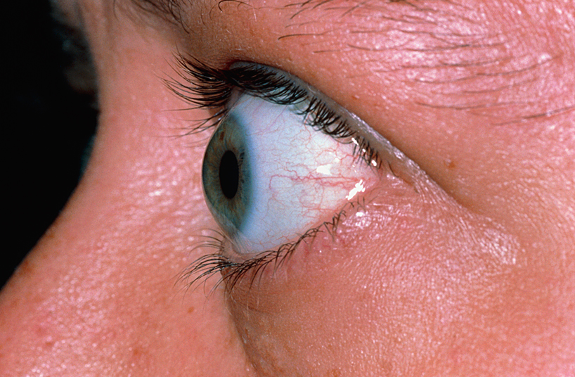 Болезнь выпученных глаз