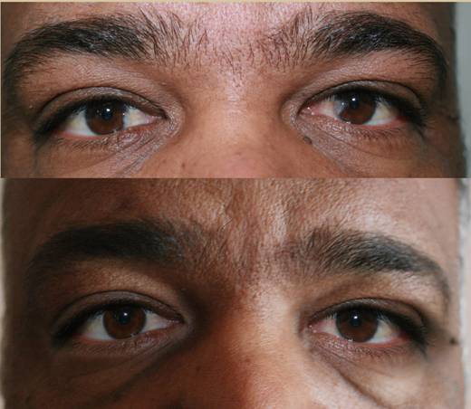 до и после удалению птеригиума