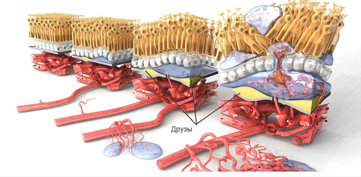 Друзы сетчатки глаза
