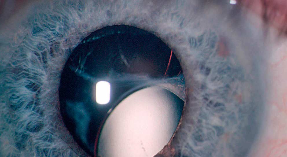 Эктопия хрусталика