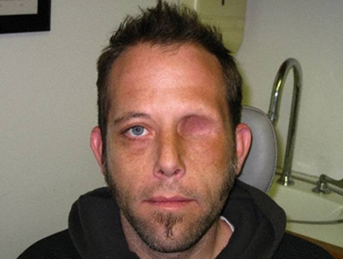 Экзентерация