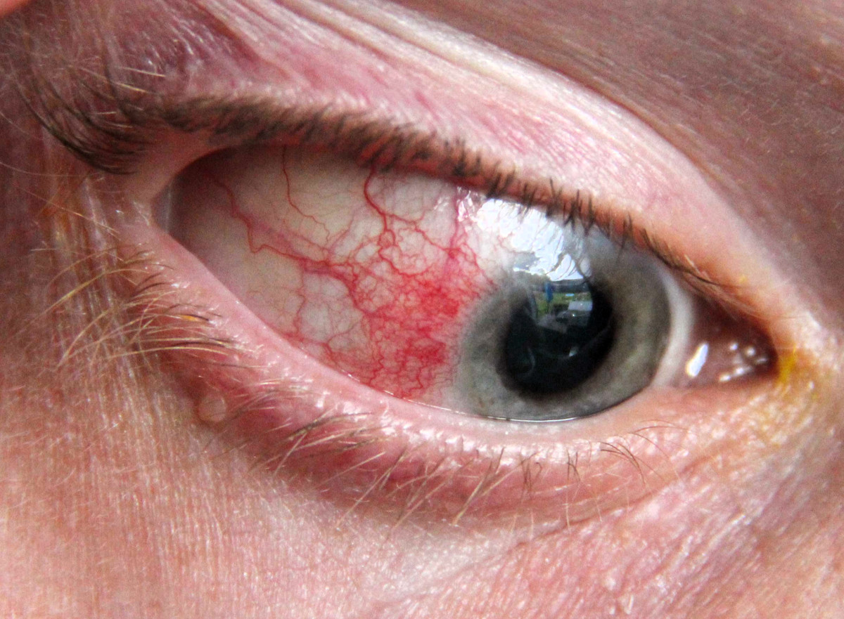 Склерит - причины, симптомы, лечение, фото