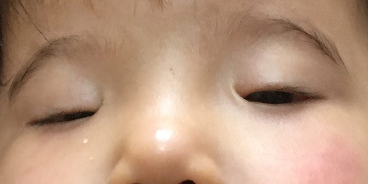 Эпикантус у детей