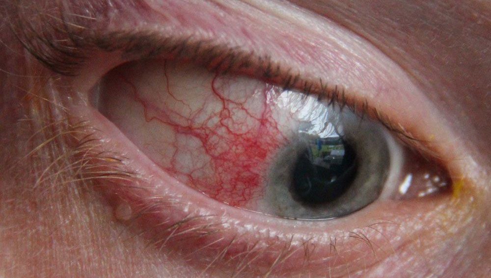 Почему белки глаз красные