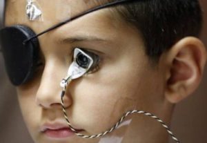 Возрастная макулодистрофия сетчатки глаза (ВМД)