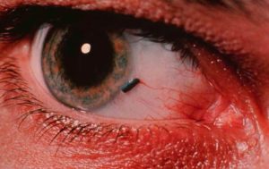 Проникающее ранение глаза