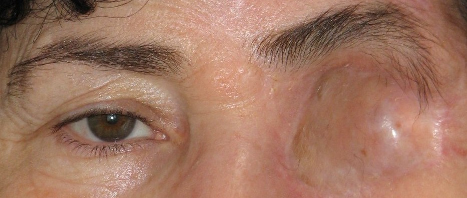 Операция по удалению глазного яблока