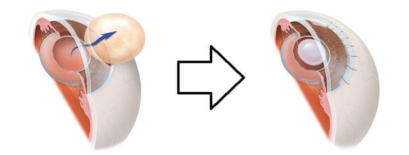 Экстракапсулярная экстракция