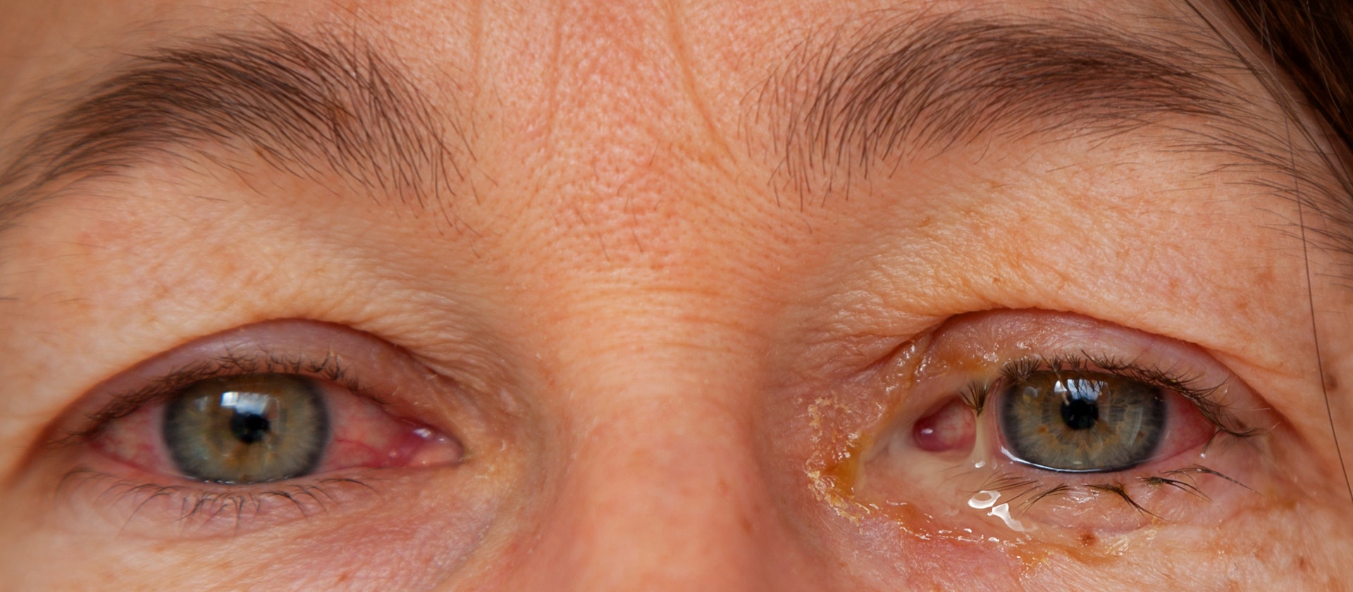 Сухой кератоконъюнктивит