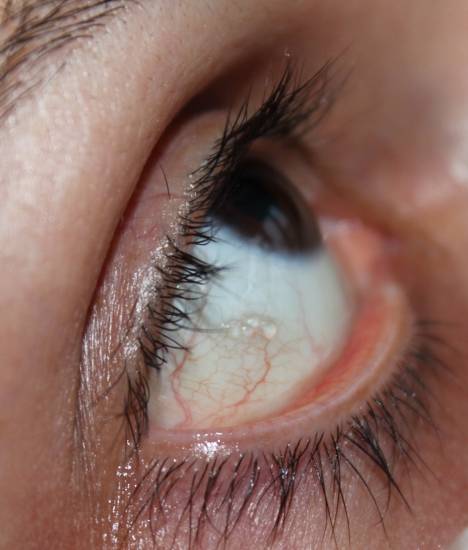 Киста конъюнктивы глаза