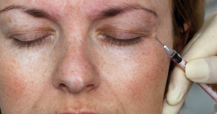 Что такое блефароспазм