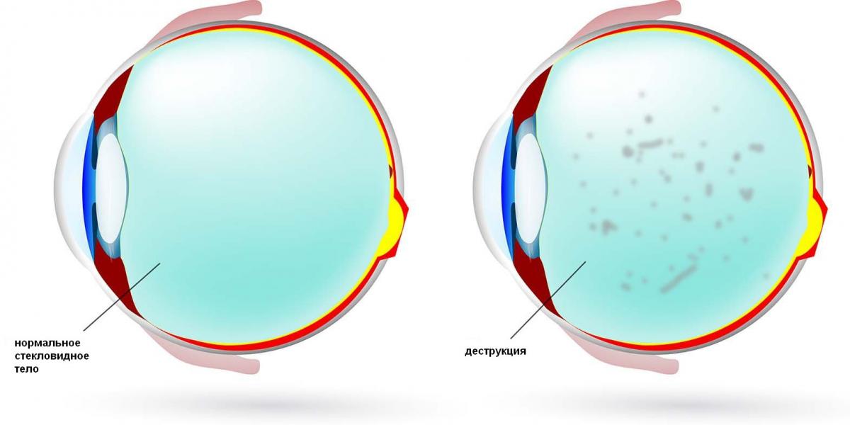 Деструкция стекловидного тела глаза