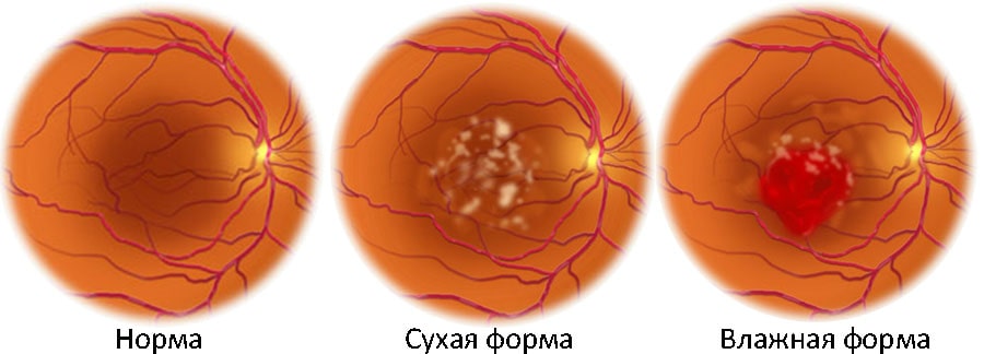 Возрастная макулярная дегенерация
