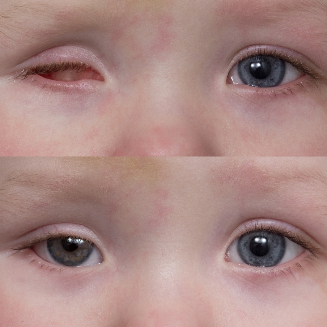 Что такое микрофтальм