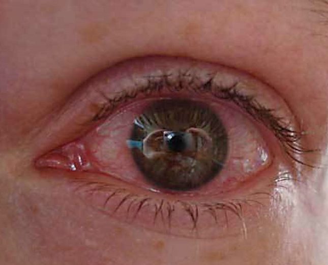 Что делать при воспалении глаз