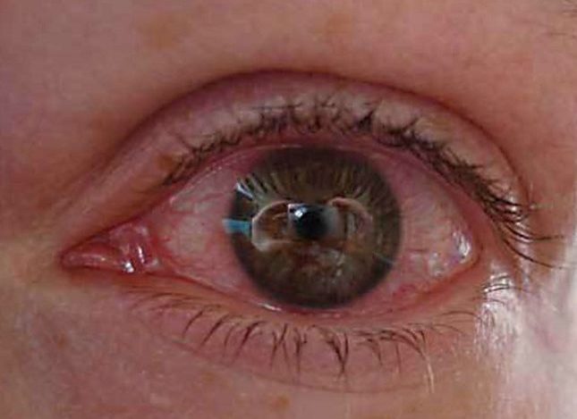 Почему болит глазное яблоко