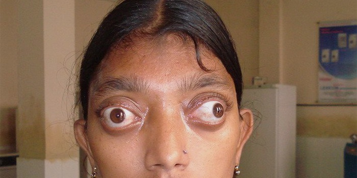 Болезнь выпученных глаз