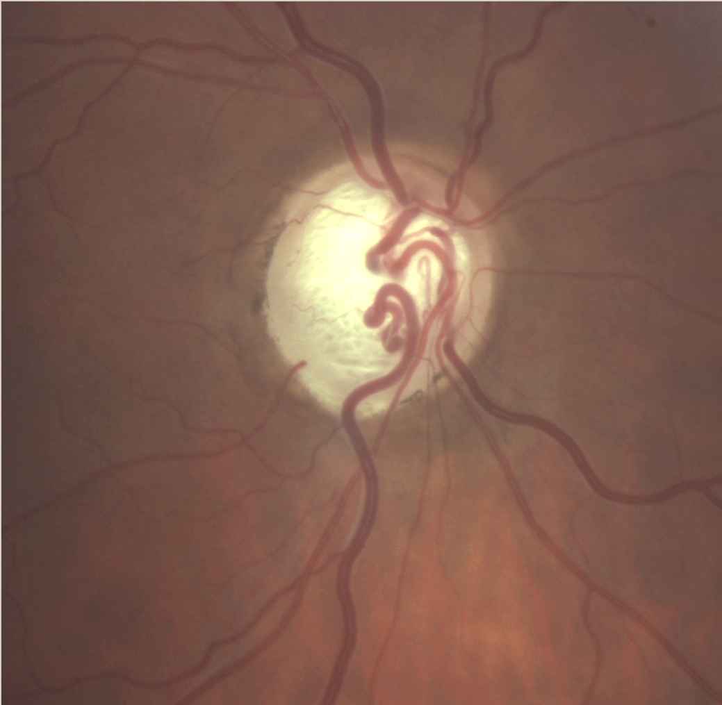 Колобома зрительного нерва