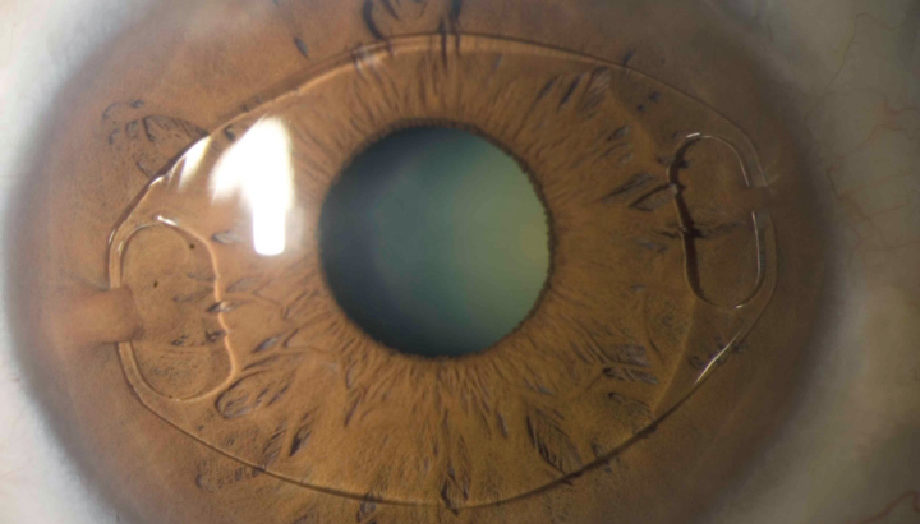 Преимущества перед другими ИОЛ