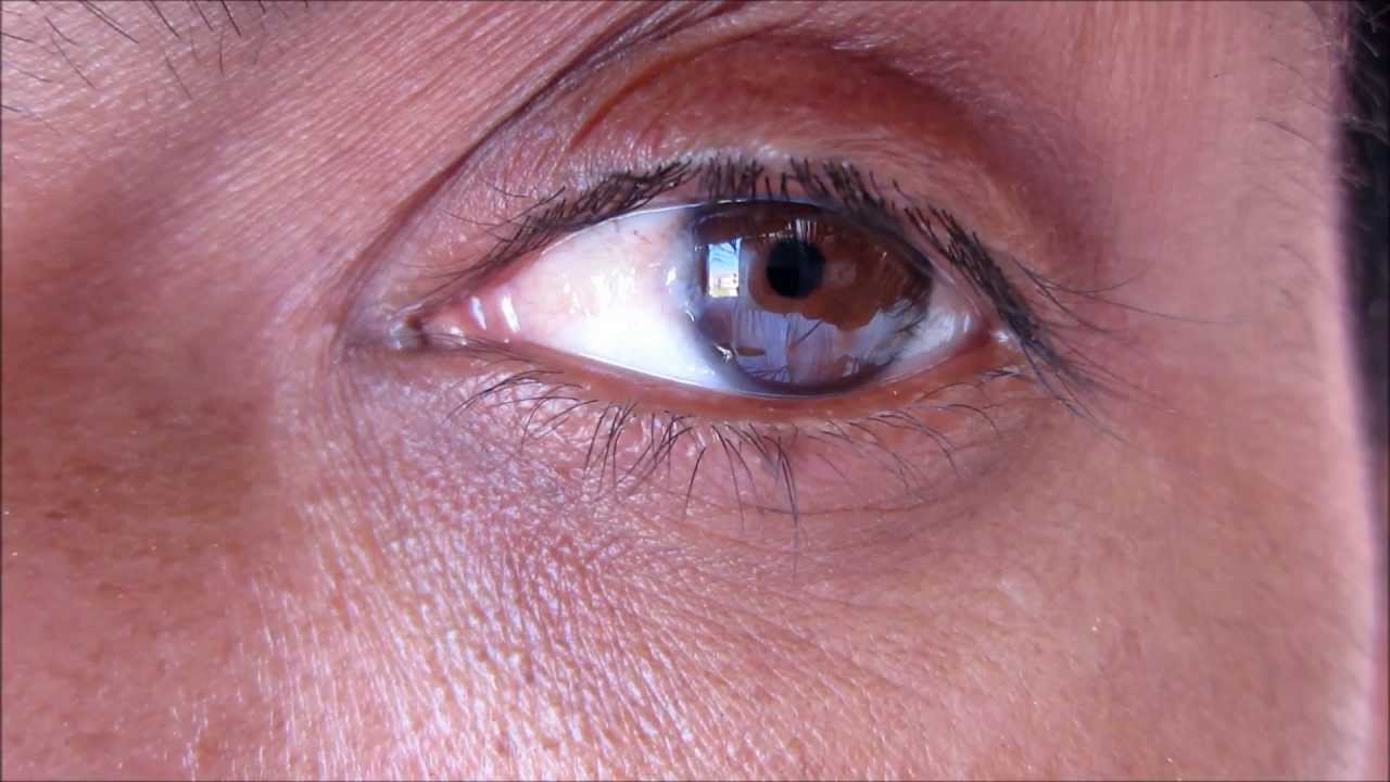 глаз зарастает пленкой
