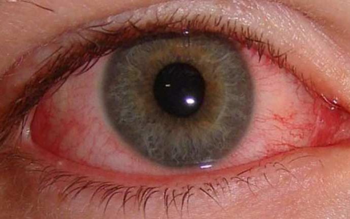 Последствия конъюнктивита, и что будет, если его не лечить