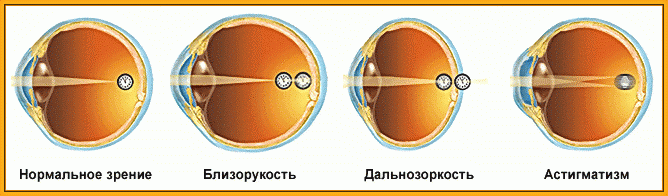 Анизометропия