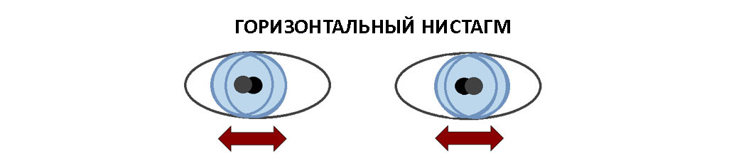 Горизонтальный нистагм
