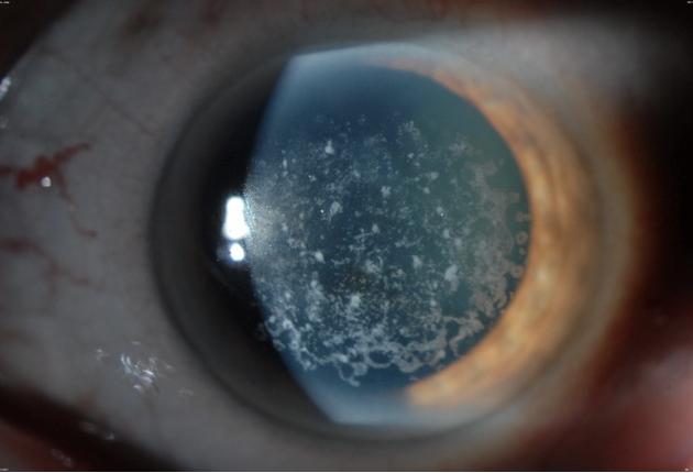 Эндотелиально-эпителиальная дистрофия роговицы (ЭЭД)