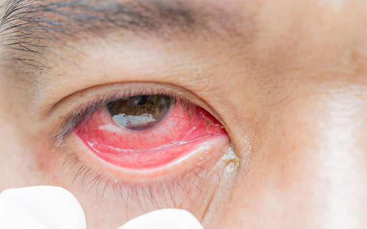 Грибковый конъюнктивит