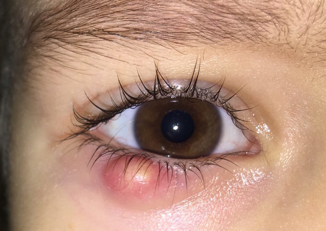 Особенности халязиона верхнего века