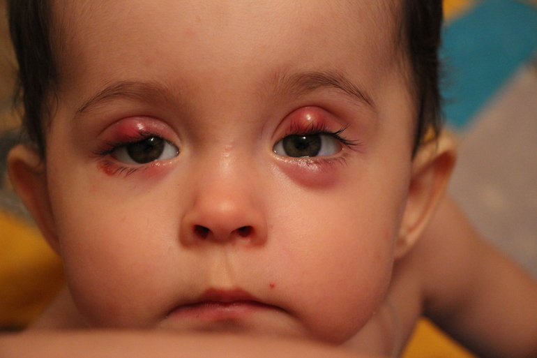 Халязион нижнего и верхнего века у ребенка