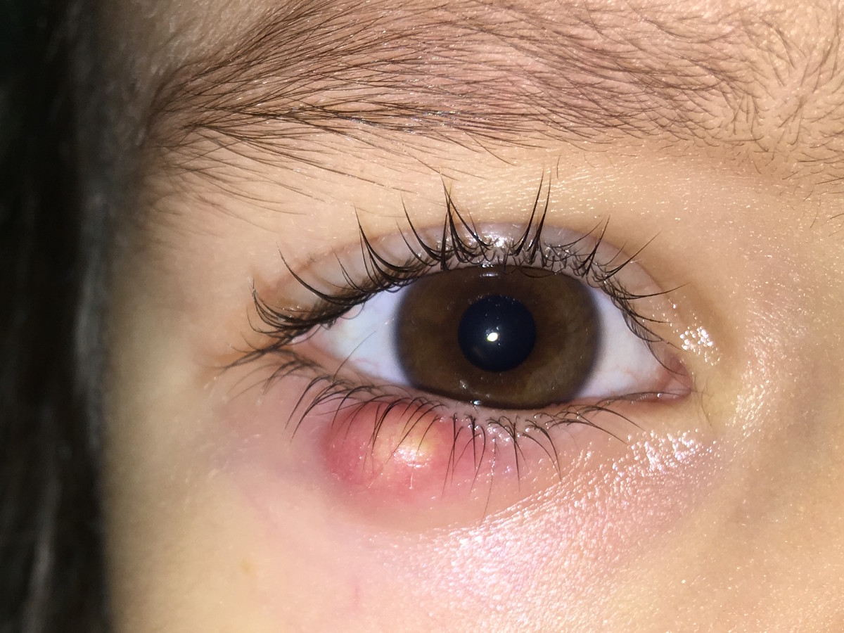 Особенности халязиона верхнего века