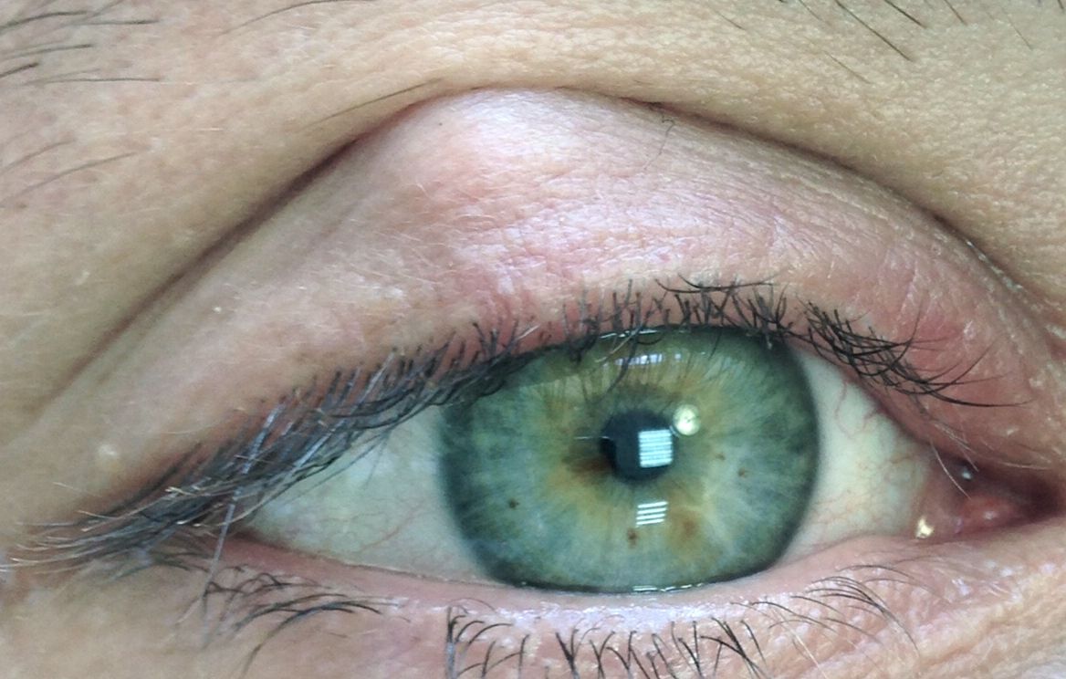 Что такое халязион