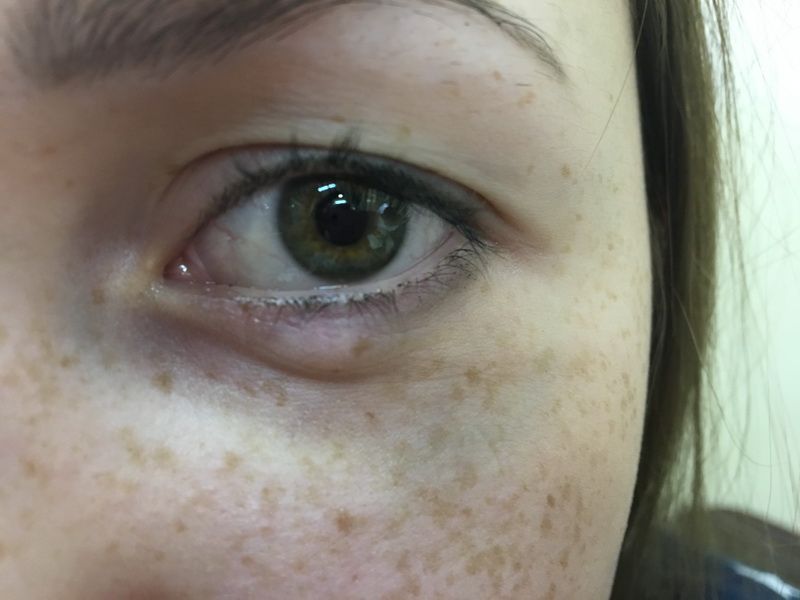 Осложнения