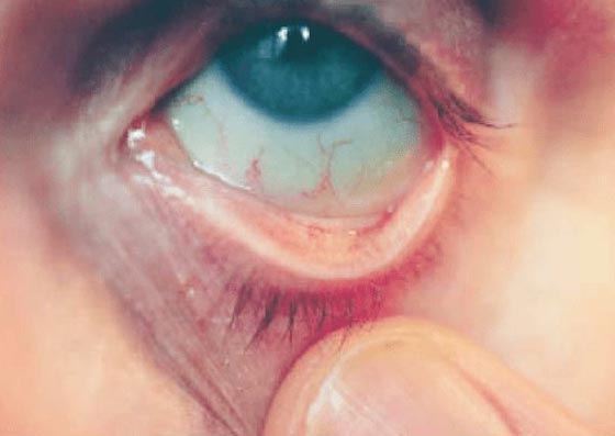 Что такое конъюнктивальный мешок - строение, особенности