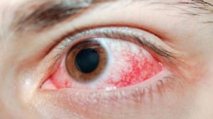 Химический ожог глаза