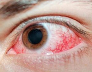 Ожог сетчатки глаза