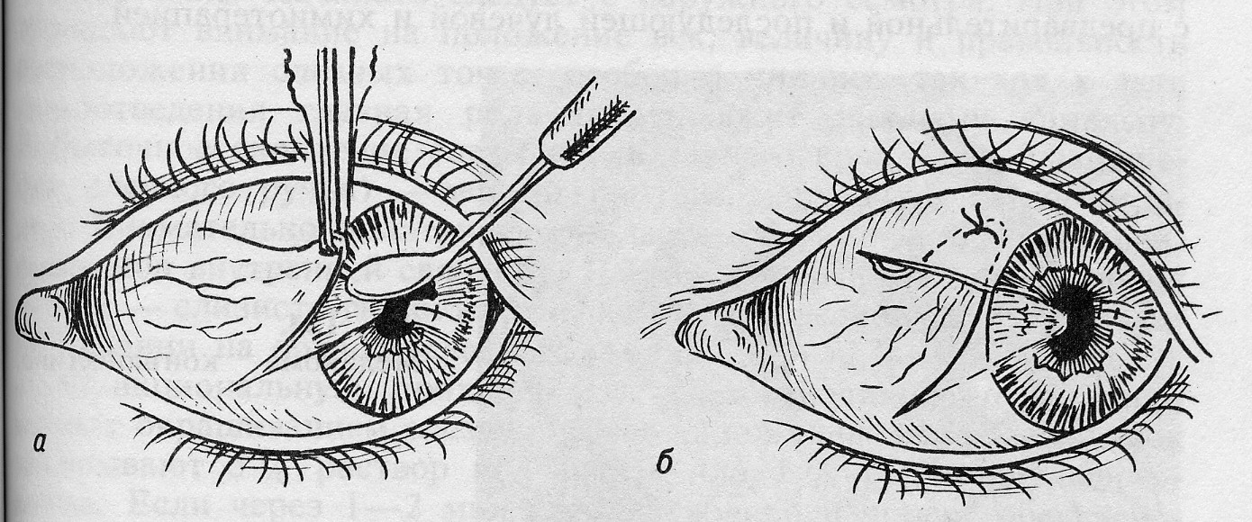 хирургическое иссечение птеригиума