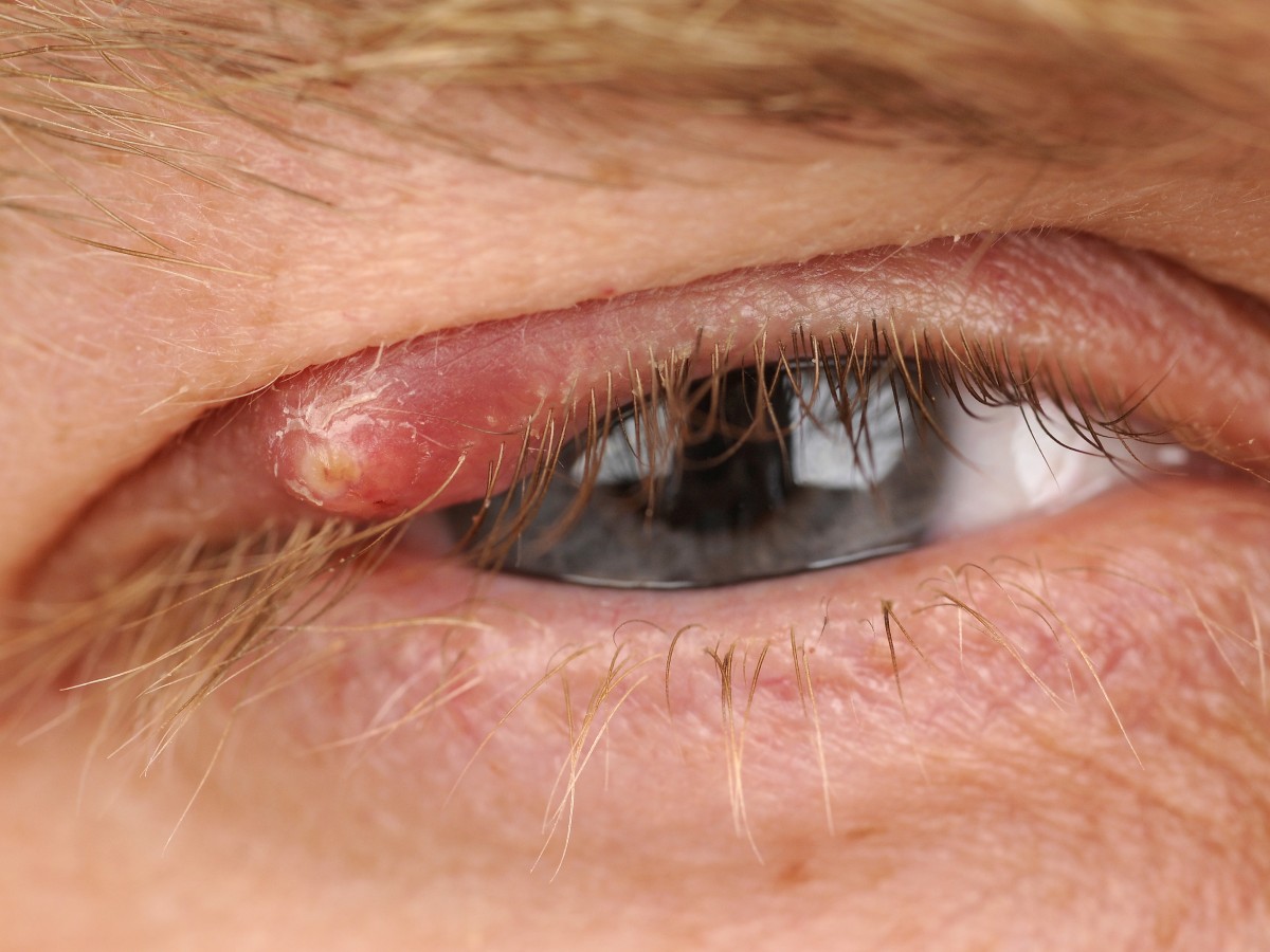 Жжение в глазах - почему глаза горят