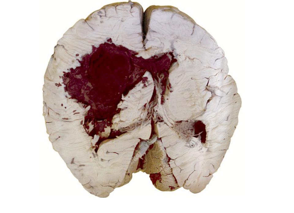 Анизокория