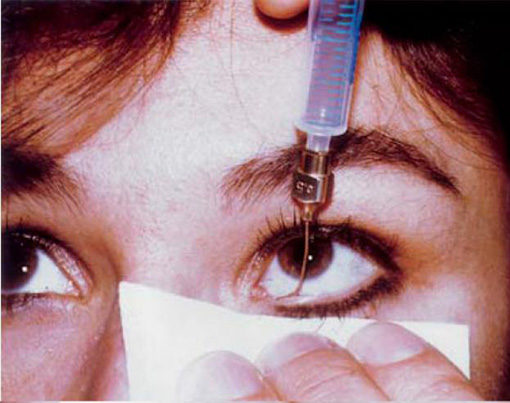 Как промывают слезный канал