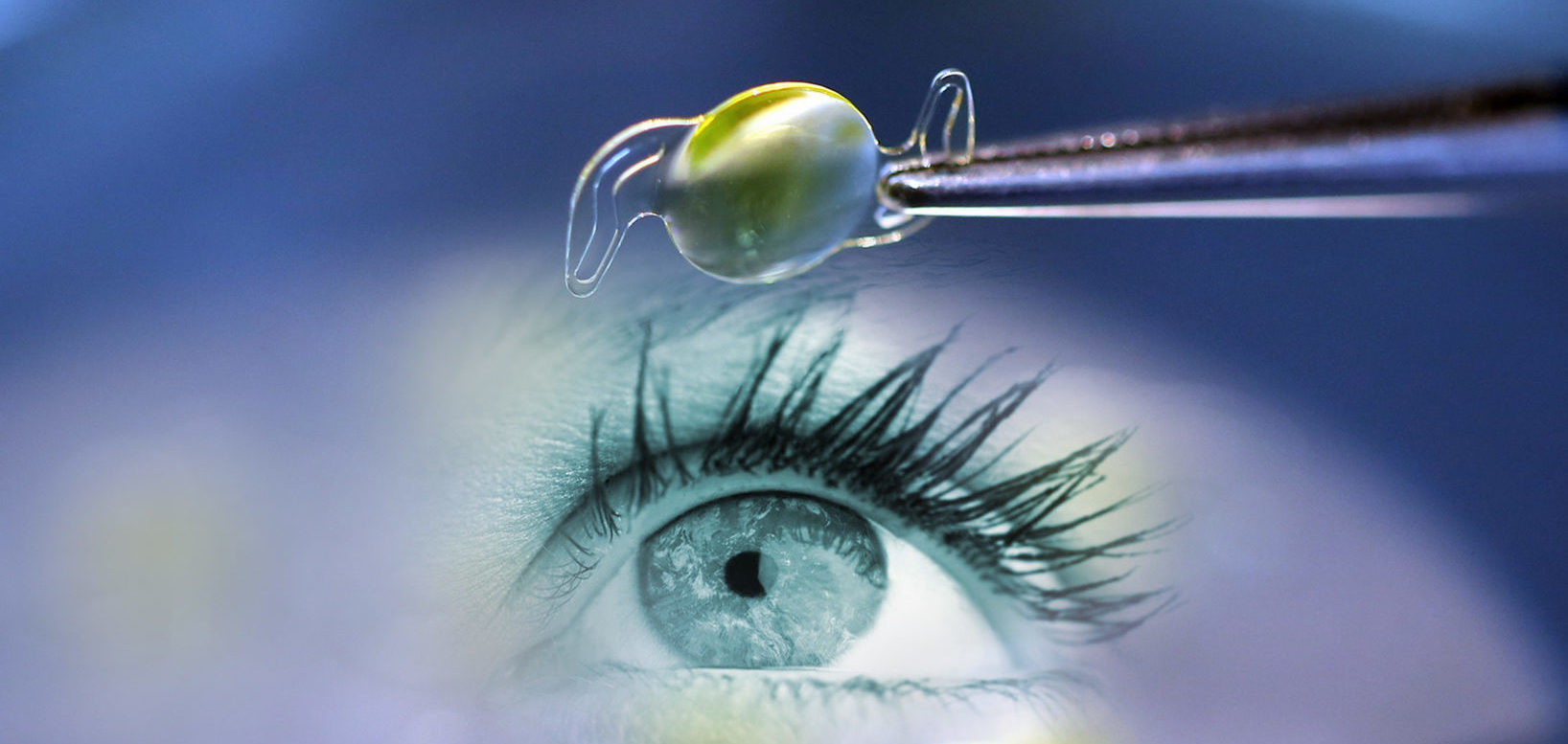 Что это факичная ИОЛ - эффективность имплантации